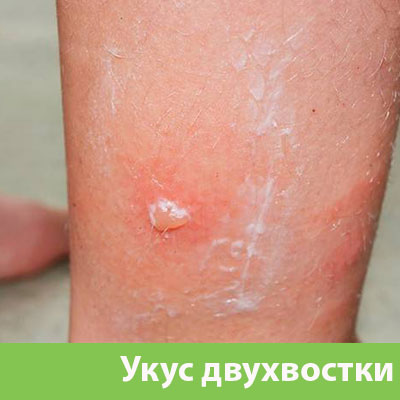Укус двухвостки в Дзержинске