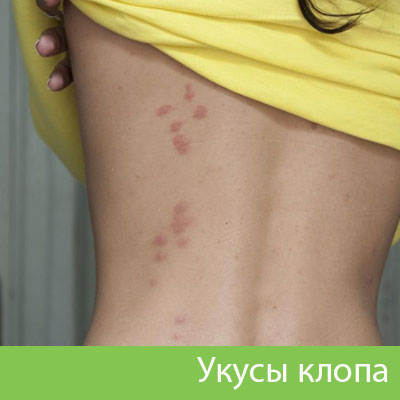 Профессиональное уничтожение клопов в Дзержинске